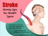 Stroke Warning Signs You Shouldn’t Ignore !