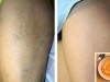 The Most Effective Natural Treatment For Varicose Veins