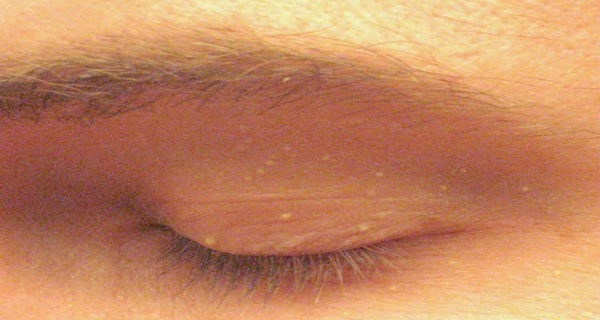 Do You Ever Get Little White Spots On Your Face Like This Here’s What It Could Mean…
