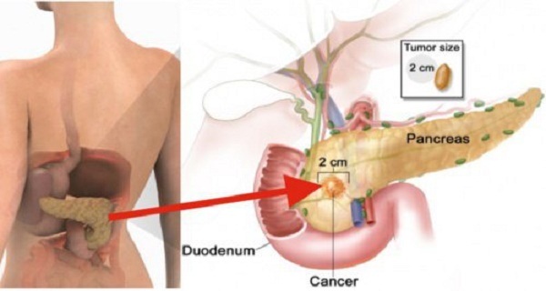 Eating Only 2 Pieces Of This Increases Your Risk Of Pancreatic Cancer