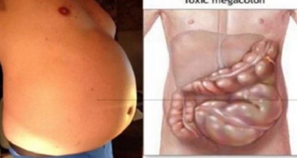 You Are Not Fat! Your Stomach Is Bloated And Here Is How To Get Rid Of It!