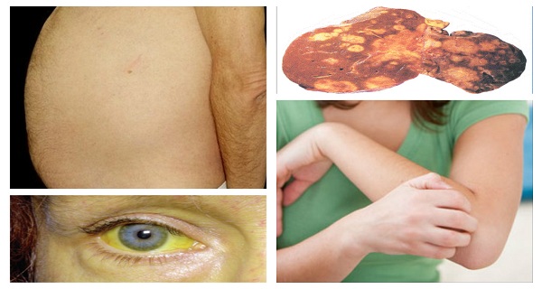 Most Common Symptoms Of Fatty Liver And The Best Way To Cleanse It