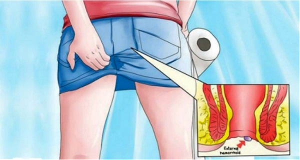 they-itch-you-and-they-bleed-here-is-one-natural-solution-for-healing-2212
