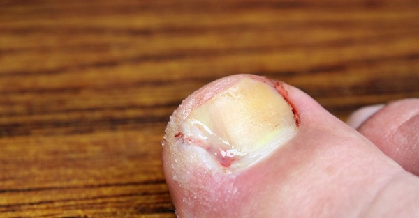 How-To-Handle-Toenail-Fungus