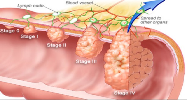 How To Prevent Colorectal Cancer Naturally