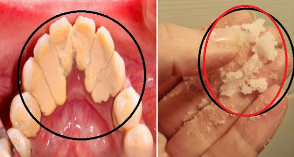 This Trick Will Help You Remove Tartar Buildup At Home In No Time