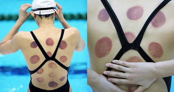5-benefits-of-cupping-therapy-everyone-should-know