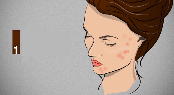 5-home-remedies-for-acne