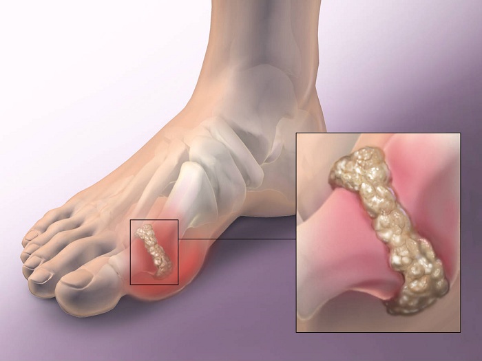 how-to-quickly-remove-uric-acid-crystallization-from-your-body-to-prevent-gout-and-joint-pain