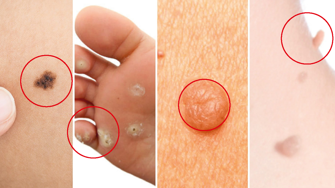 Detailed-recipes-to-remove-common-skin-problems-(warts,-skin-tags,-oil-clogs)-naturally-at-home